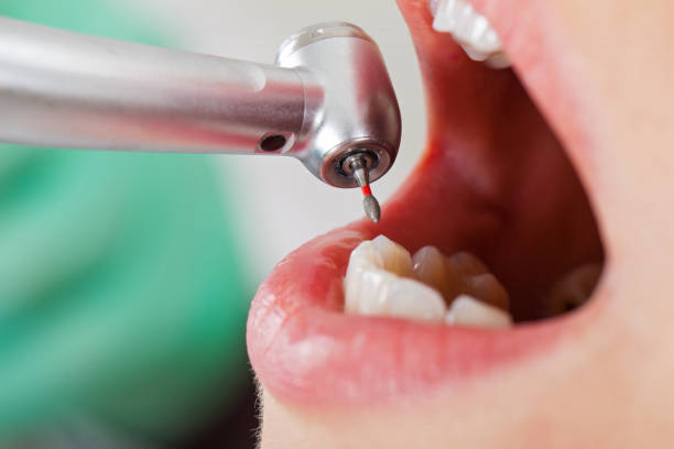 Best Emergency Dentist for Knocked-Out Tooth in Ypsilanti, MI
